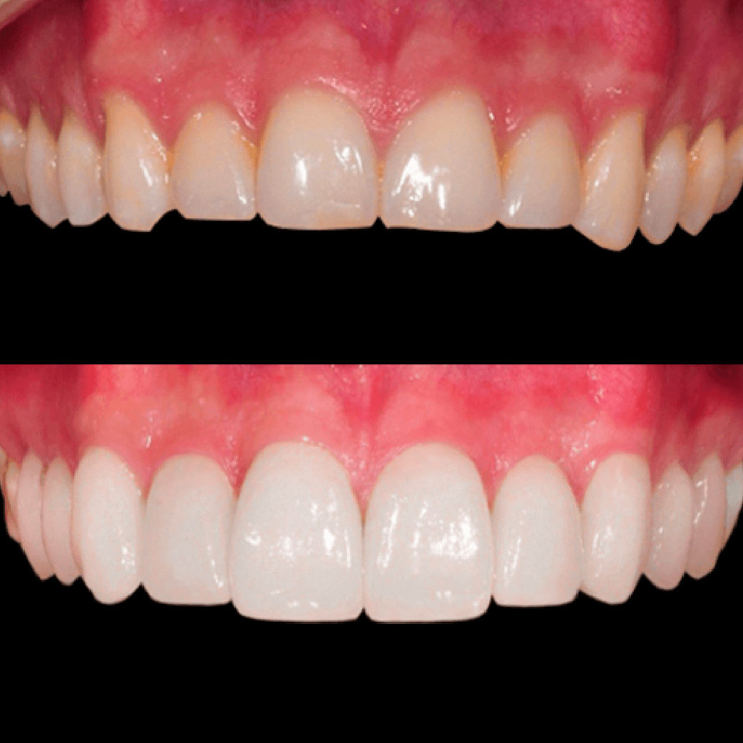 carillas dentales antes y despues