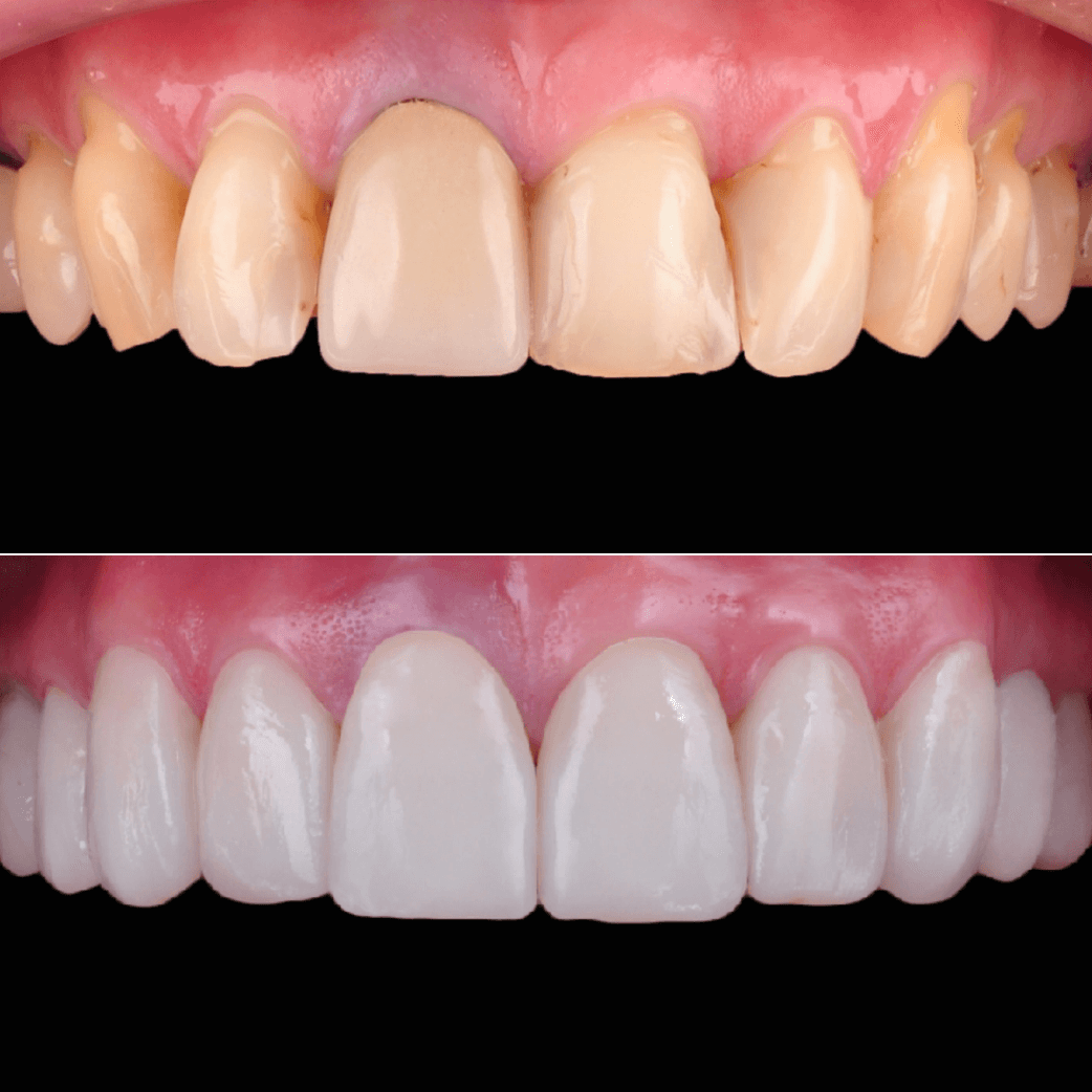 carillas dentales fotos antes y después