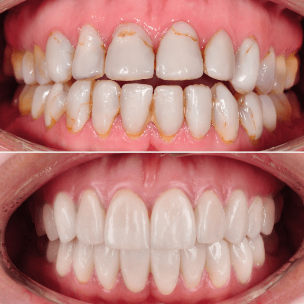carillas dentales antes y despues