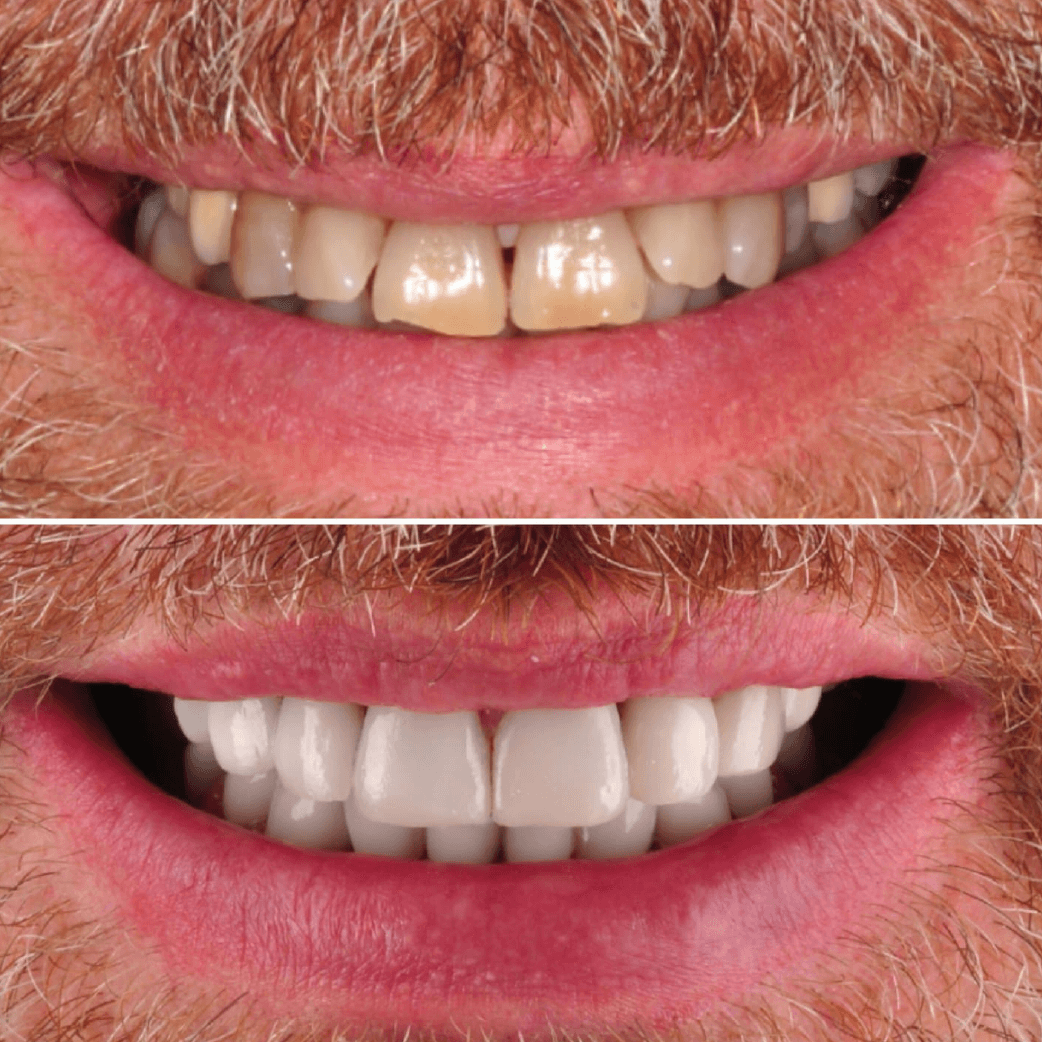 carillas dentales antes y despues