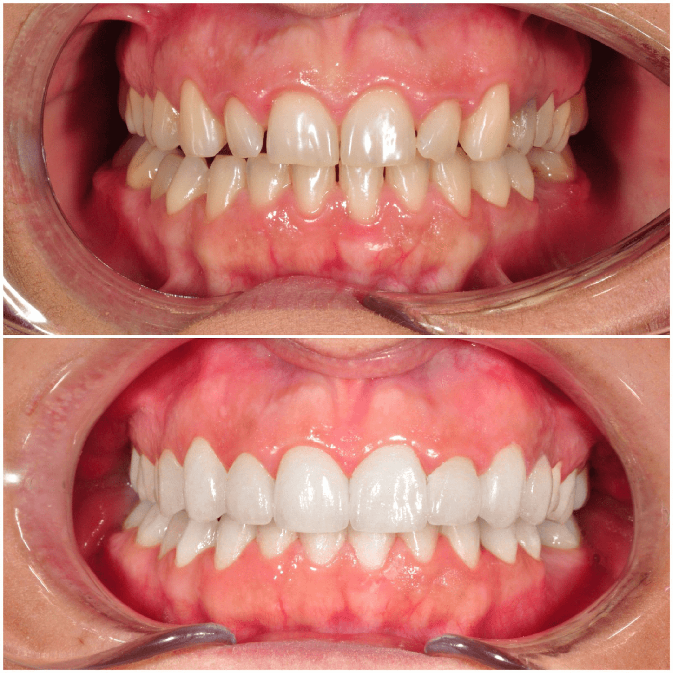 carillas dentales antes y después