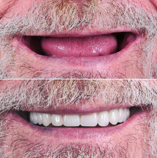 antes y después implantes dentales