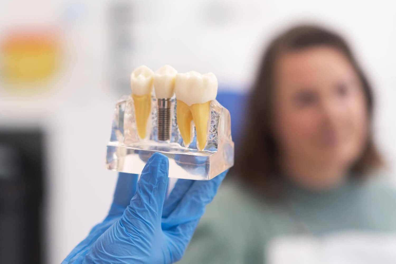 imagen implantes dentales