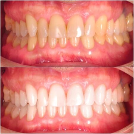 foto página de blanqueamiento 1 (1) (1) (1) (1) blanqueamiento dental madrid