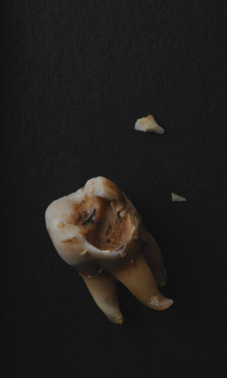 4639 caries y halitosis o mal aliento