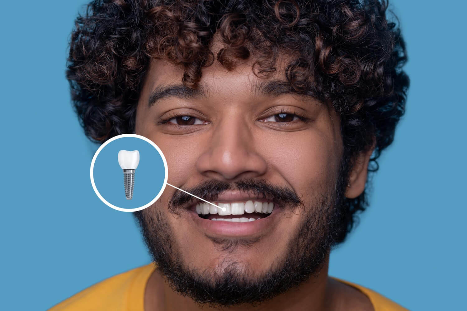 postoperatorio implantes dentales