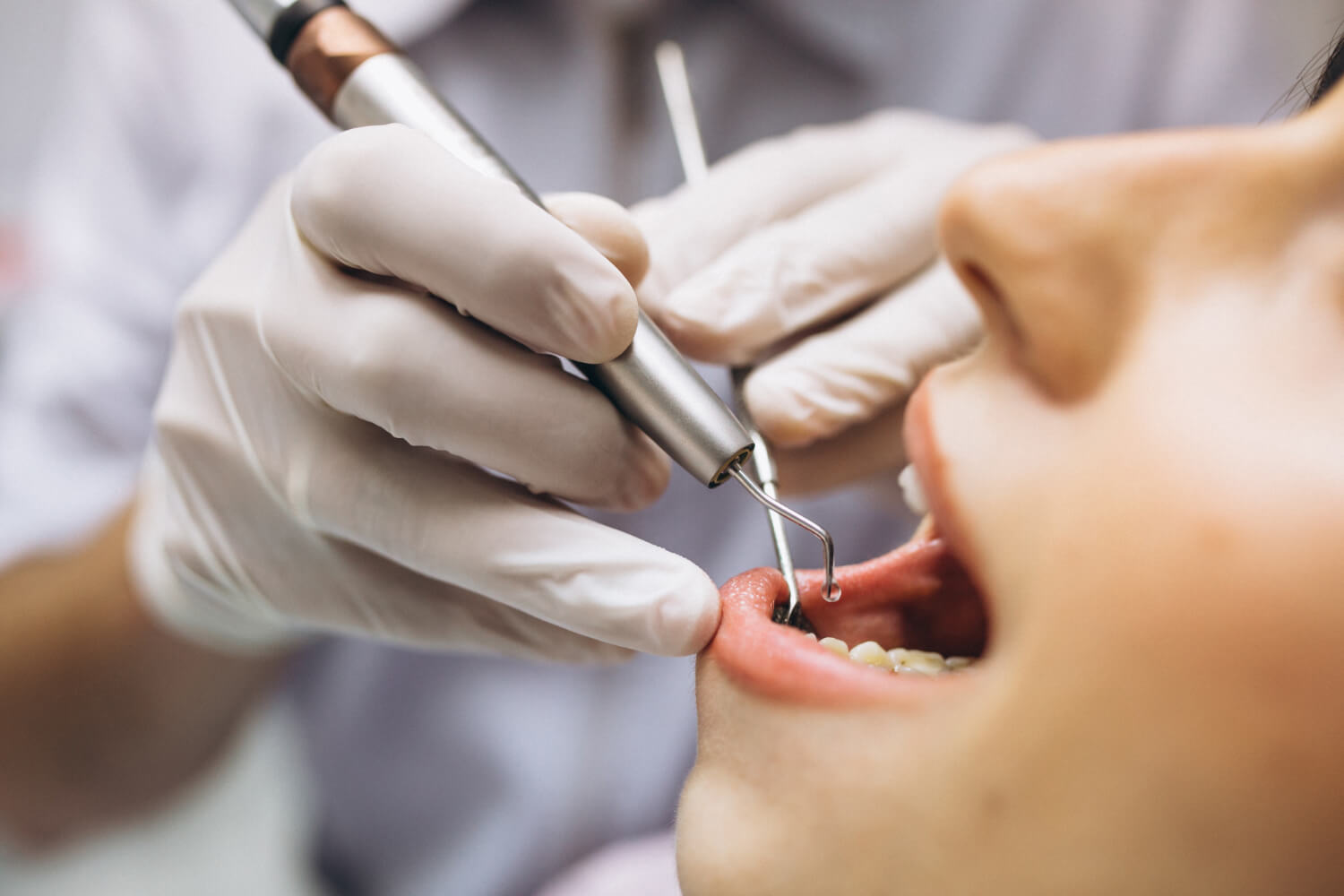 dentista en Madrid poniendo un empaste