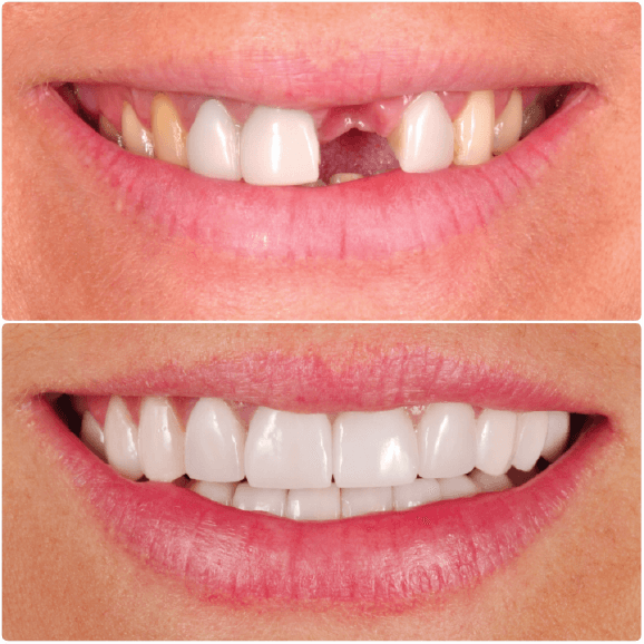 carillas dentales antes y después