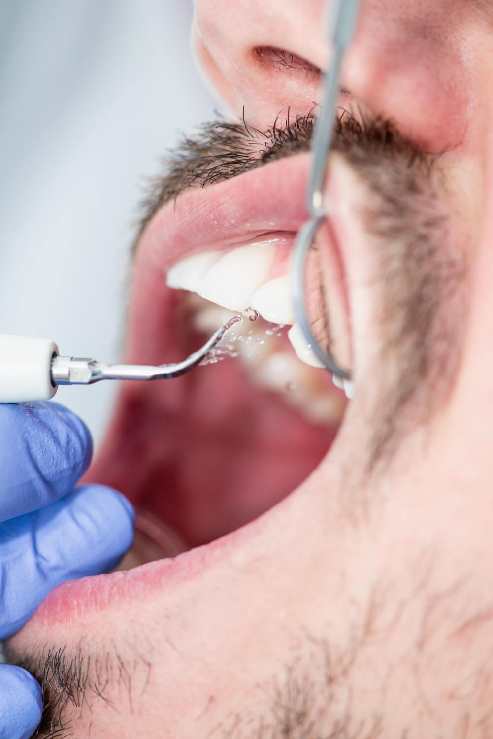 curetaje dental