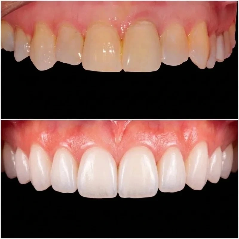 Antes y después de tratamiento con carillas dentales para blanqueamiento y alineación en clínica dental Robledo Martín Madrid