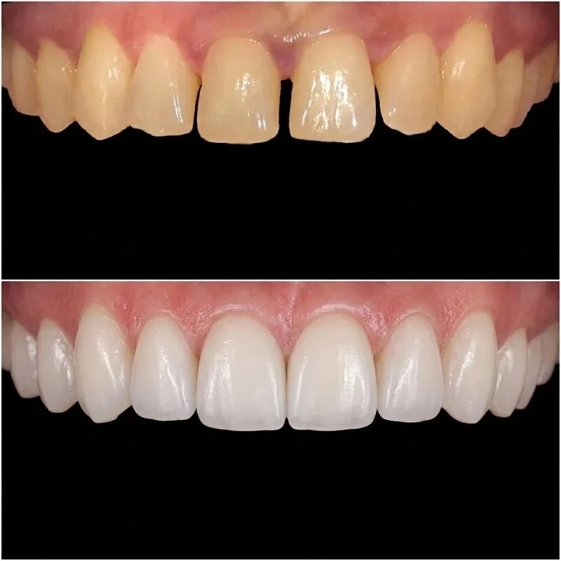 Antes y después del tratamiento con carillas dentales para cierre de diastema en Madrid