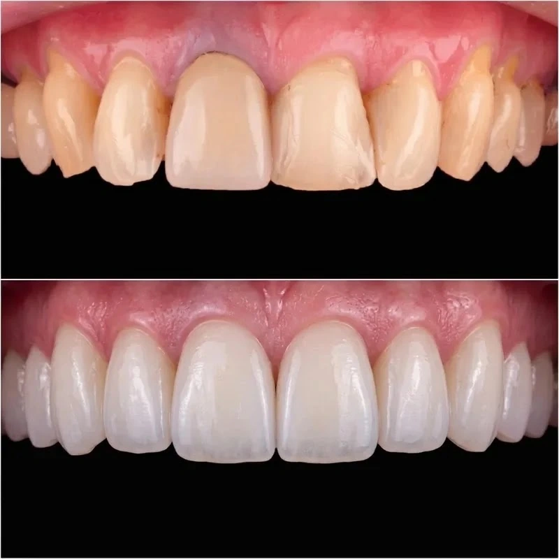 Tratamiento de carillas de porcelana antes y después en dientes con desgaste e tinción